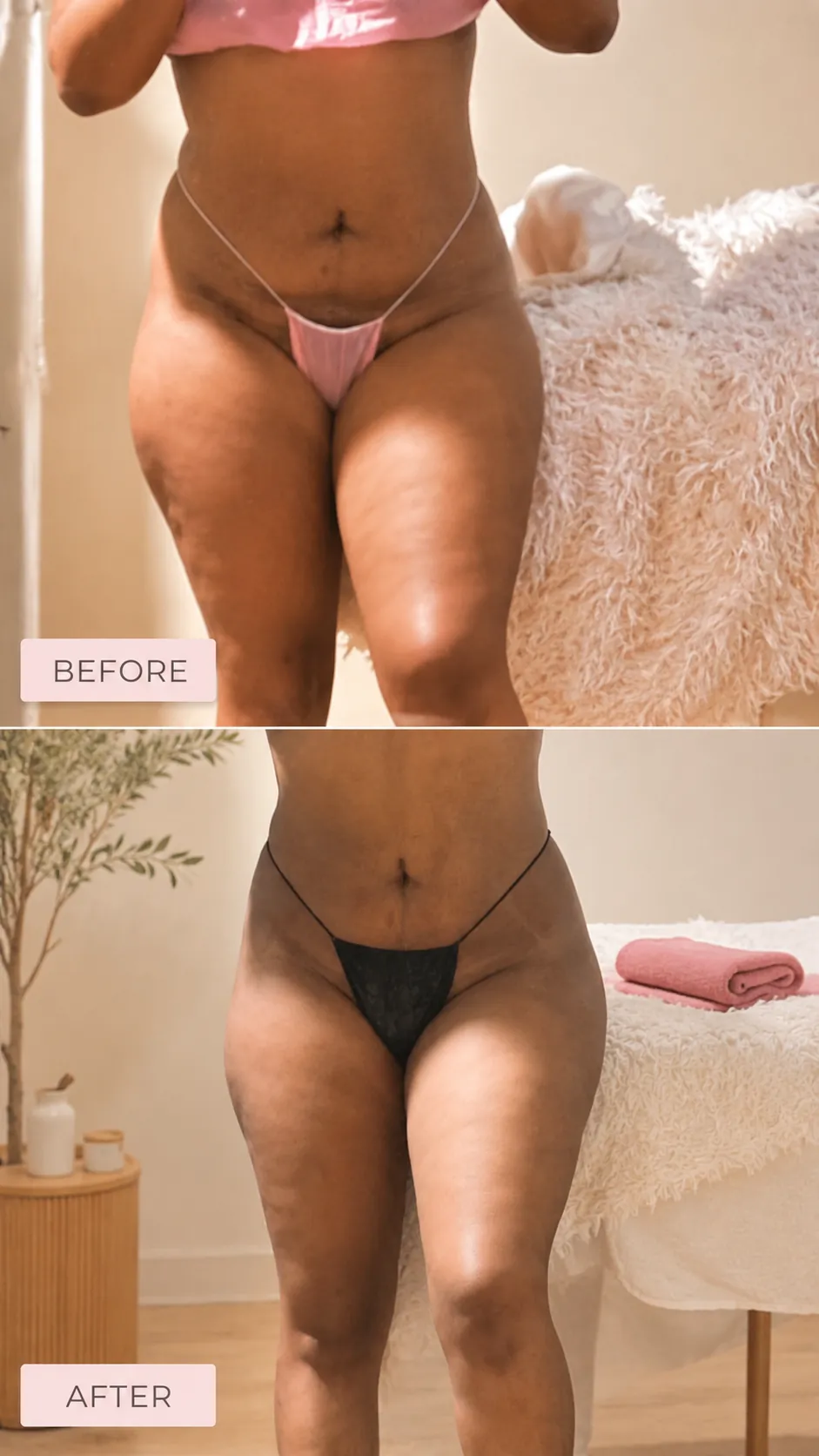 Kiana – Skin Tightening before & after