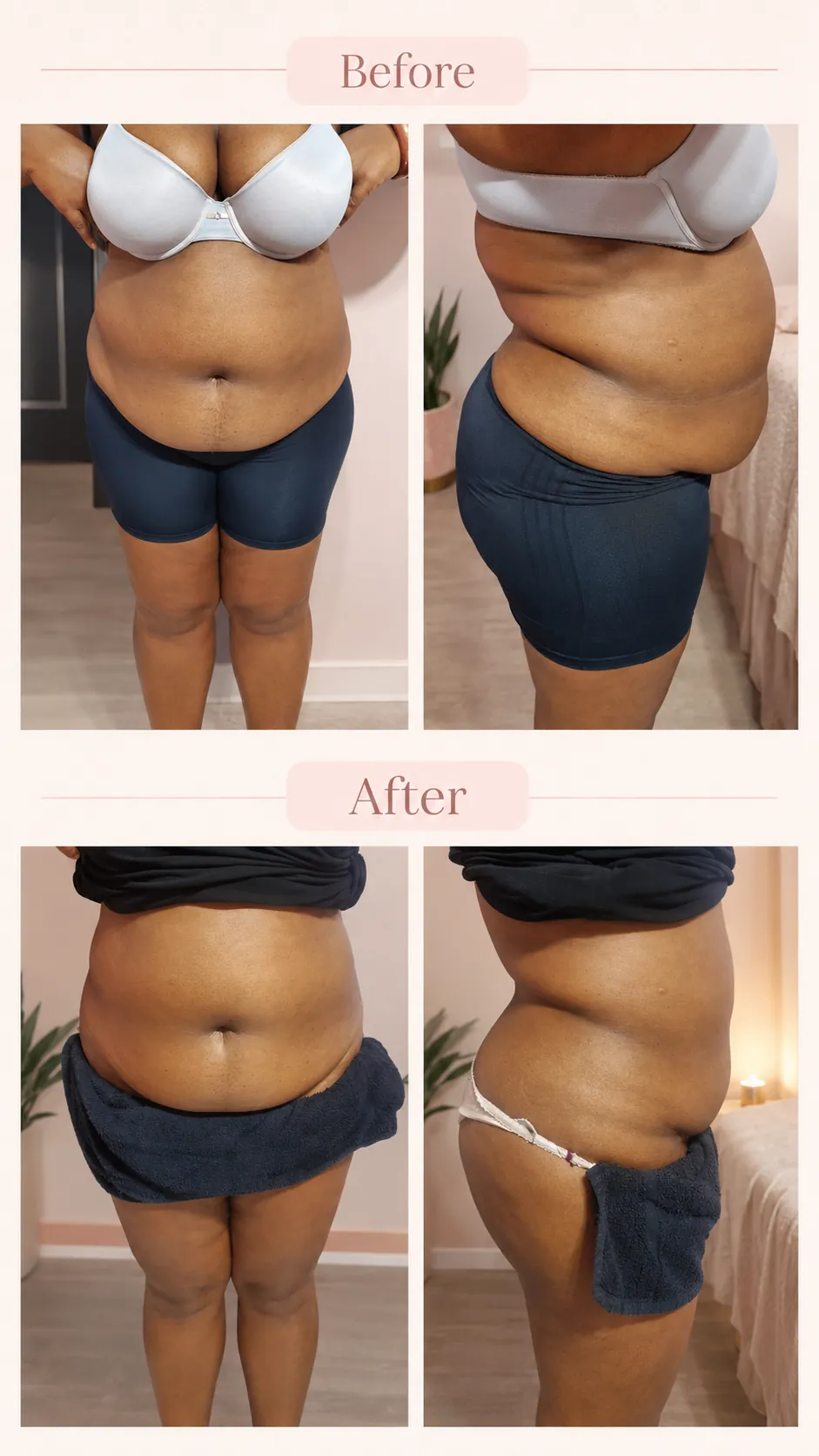 Naomi – Stretch Mark Care before & after